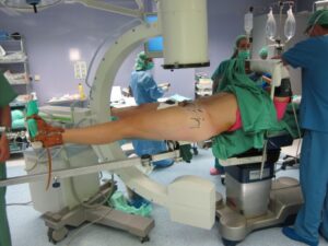 colocacion-artroscopia-cadera-dr-bernaldez-sevilla